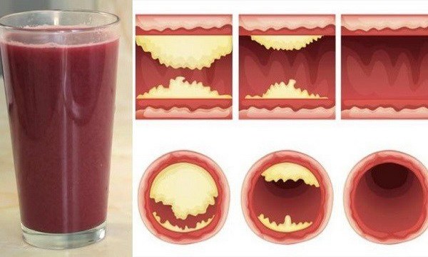 10 Foods That Unclog Arteries Naturally And Protect Against Heart Attack